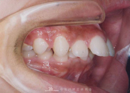 【症例７】成長期の出っ歯の治療