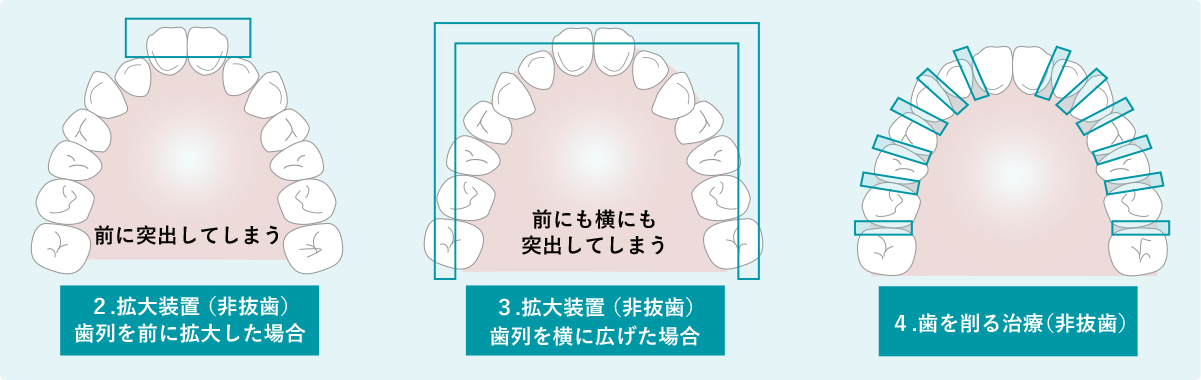 １抜歯治療,２拡大装置（非抜歯）