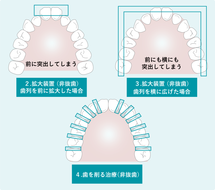 １抜歯治療,２拡大装置（非抜歯）